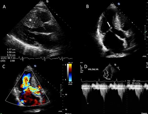 echocardiogram normal and abnormal findings.
